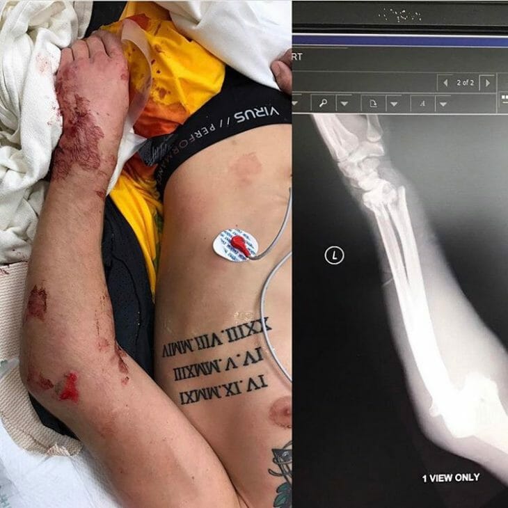 Ken Roczen Injury Update